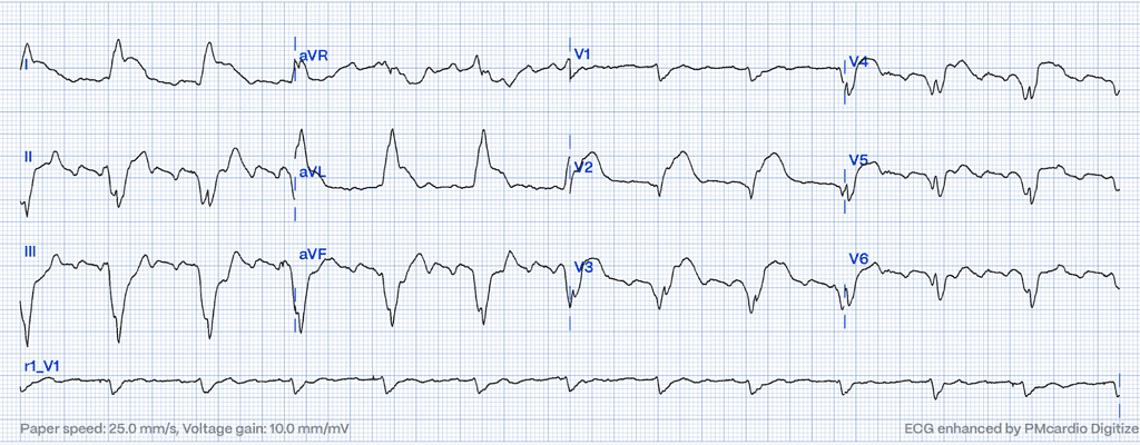 Sgarbossa Criteria: A Gateway to Advanced Cardiac Diagnosis