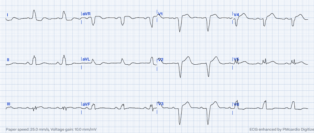 Smith-modified Sgarbossa Criteria on ECG: inus rhythm with LBBB and a ST/S ratio of 0.33 in V4, indicating discordant STE that aligns with the Modified Sgarbossa Criteria.