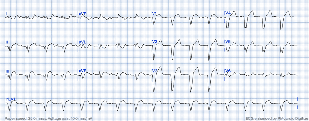 Smith-modified Sgarbossa Criteria on ECG