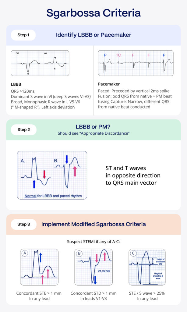 Identify Sgarbossa Criteria on ECG