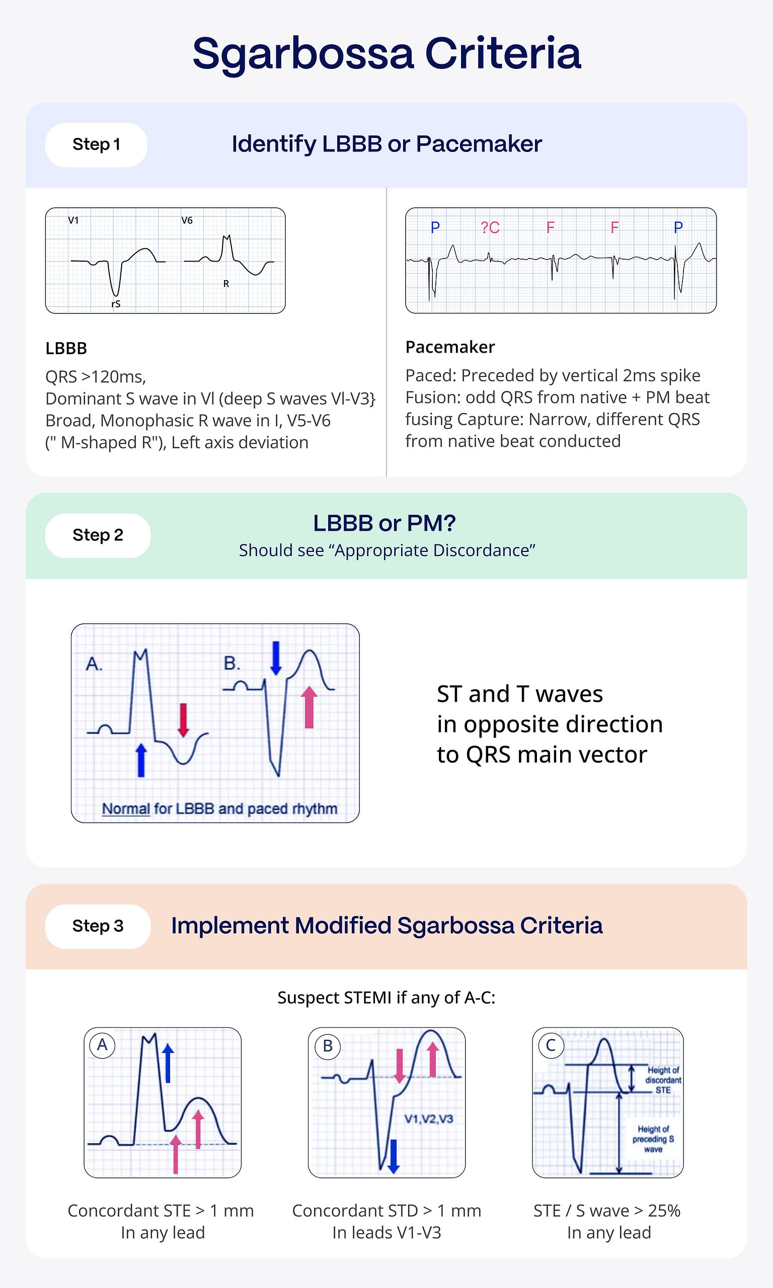 Sgarbossa Criteria: Advanced Cardiac Diagnosis | PMcardio