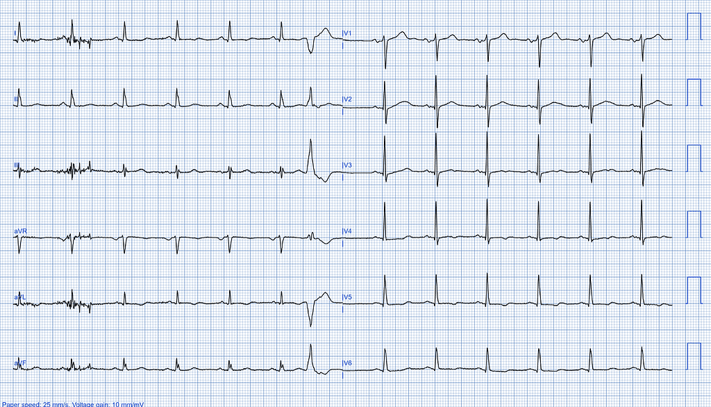 Left Ventricular Systolic Dysfunction graph ECG case 1 Asymptomatic LVSD