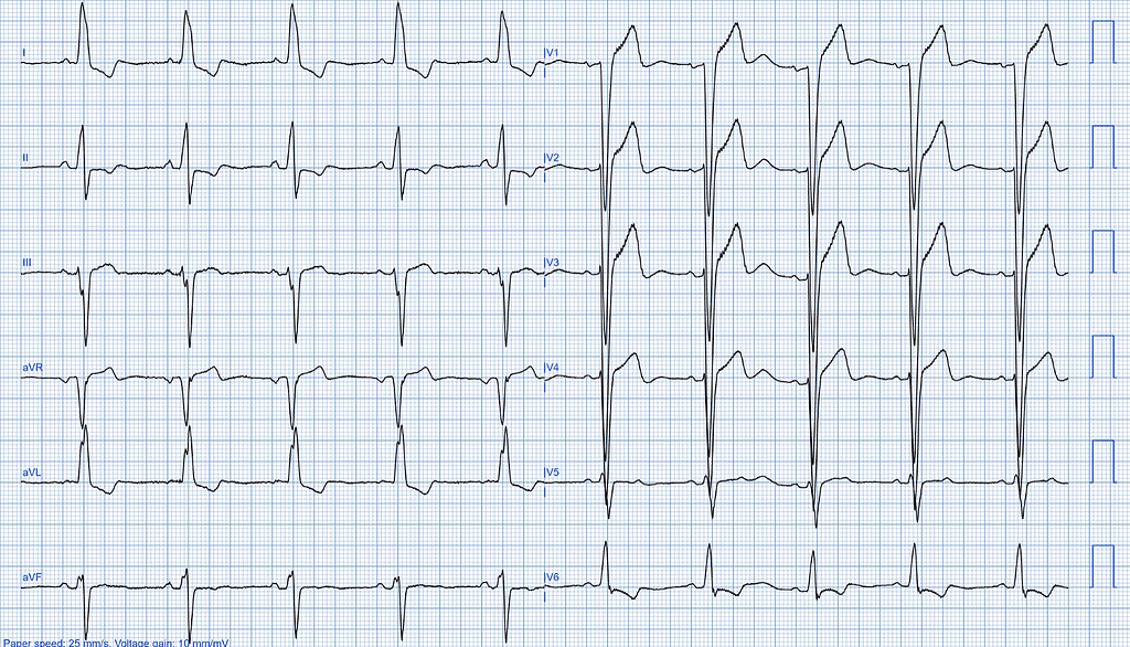 Left Ventricular Systolic Dysfunction ECG Case 2: Moderate LVSD