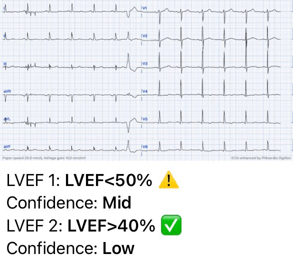 Left Ventricular Systolic Dysfunction graph ECG case 1 AI analysis Asymptomatic LVSD