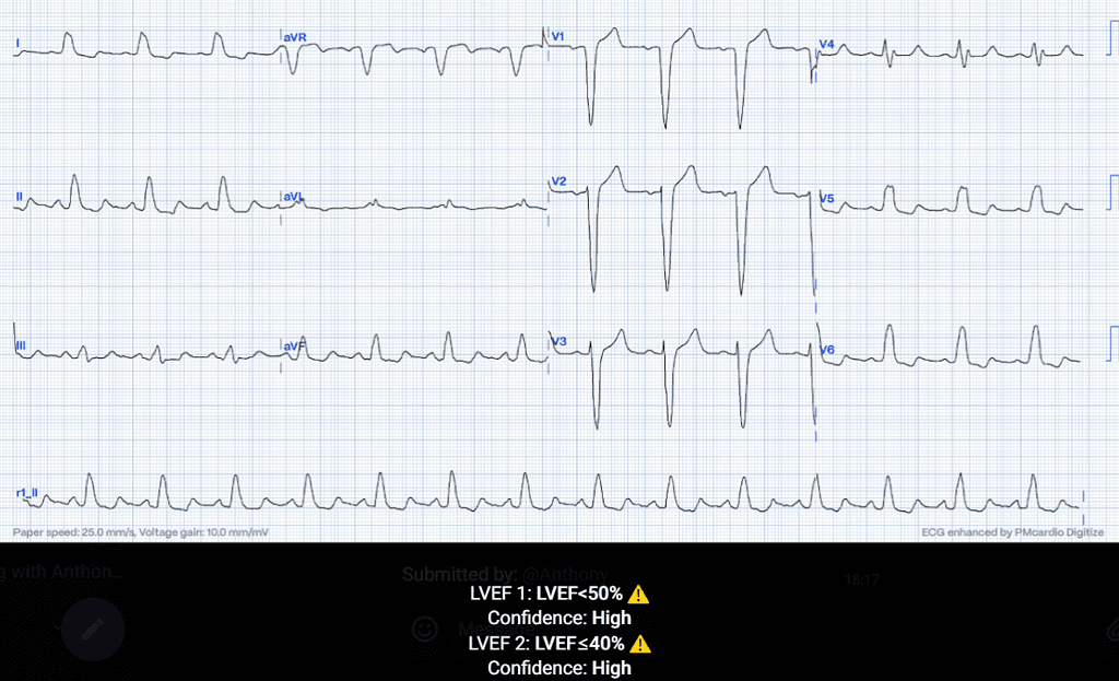 Left Ventricular Systolic Dysfunction ECG Case 4 