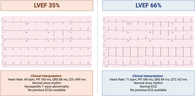 Left Ventricular Systolic Dysfunction graph