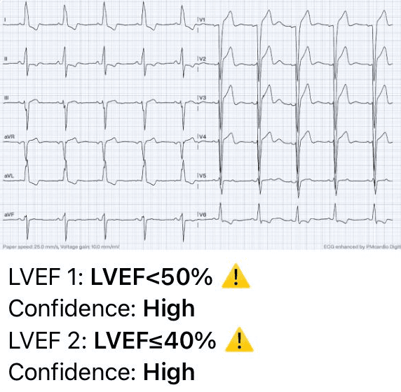 Left Ventricular Systolic Dysfunction ECG Case 2: Moderate LVSD AI Interpretation