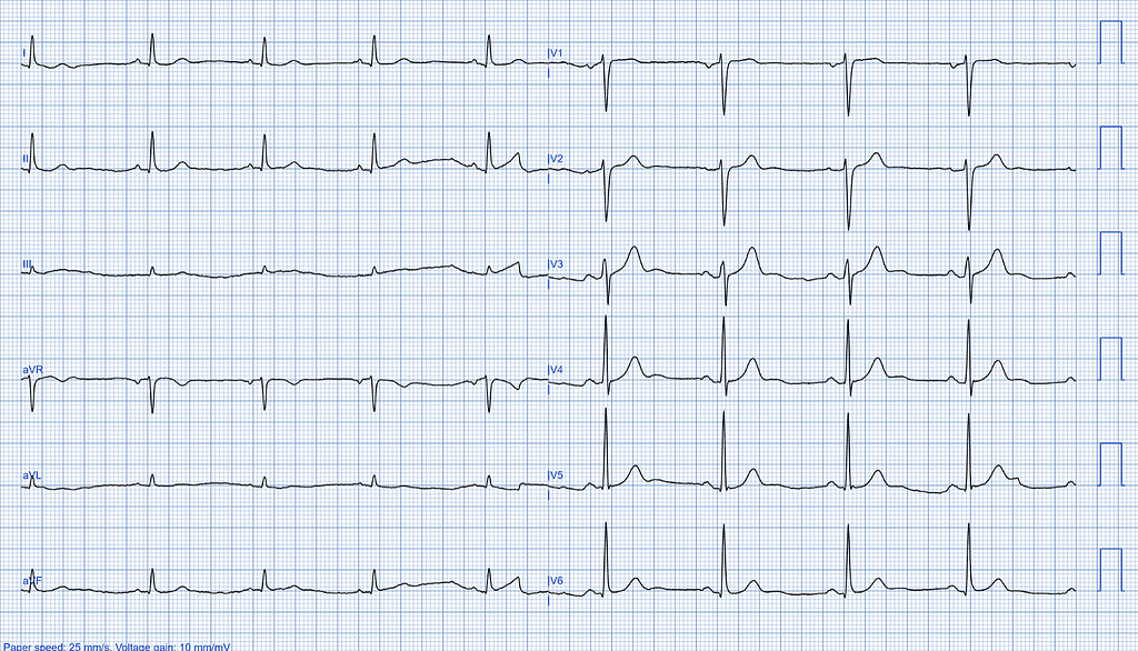 Left Ventricular Systolic Dysfunction ECG Case 3 Normal Left Ventricular Function LVSD 