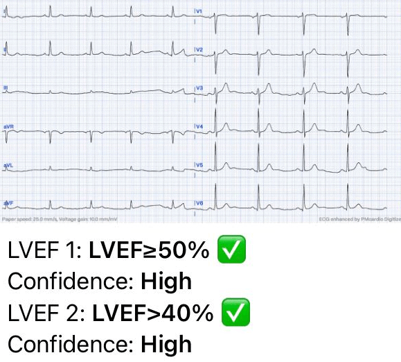 Left Ventricular Systolic Dysfunction ECG Case 3 Normal Left Ventricular Function LVSD  AI ECG  Interpretation