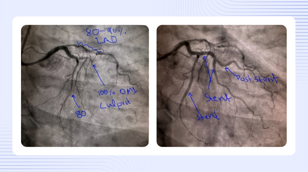 Dr. Schmelzer's Turning Point: How a Severe Chest Pain Case Inspired PMcardio Adoption