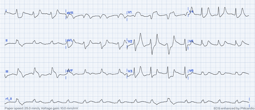 STEMI Mimics: Spot the Subtle Impostors of Myocardial Infarction