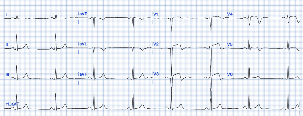 STEMI Mimics: Spot the Subtle Impostors of Myocardial Infarction