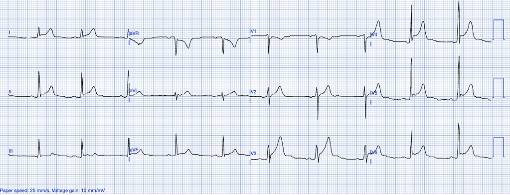 STEMI Mimics Early Repolarization