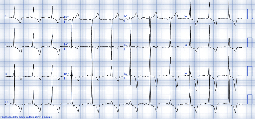 Stemi Mimics ECG Left Ventricular Hypertrophy