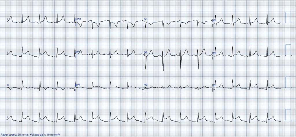 STEMI Mimics ECG Features of Pericarditis