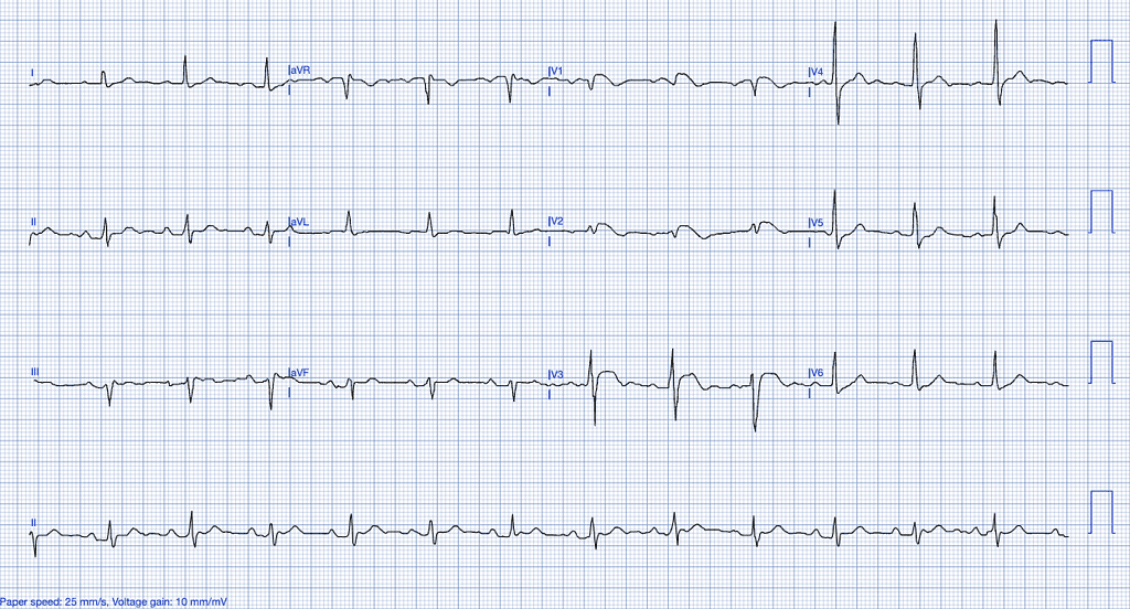 STEMI Mimics Brugada Syndrome ECG Features