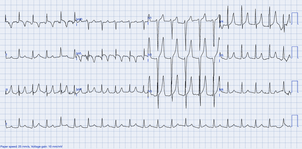 Stemi mimics ECG Features of Hyperkalemia