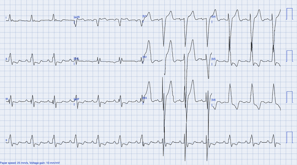 STEMI Mimics ECG Features of Previously Diagnosed LBBB ECG 