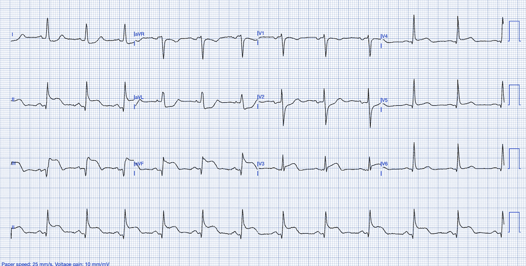 STEMI ECG criteria example of  inferior and right ventricular infarct