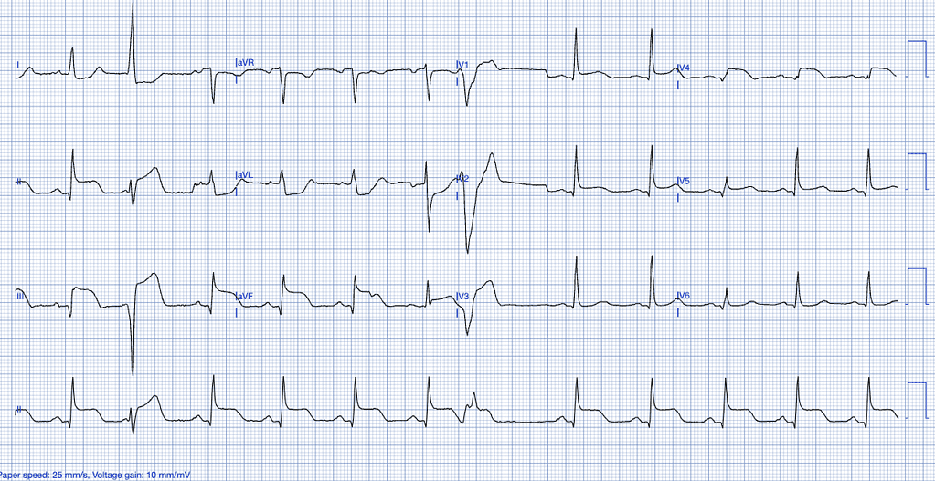 STEMI ECG Criteria Figure: ST-elevation myocardial infarction. 