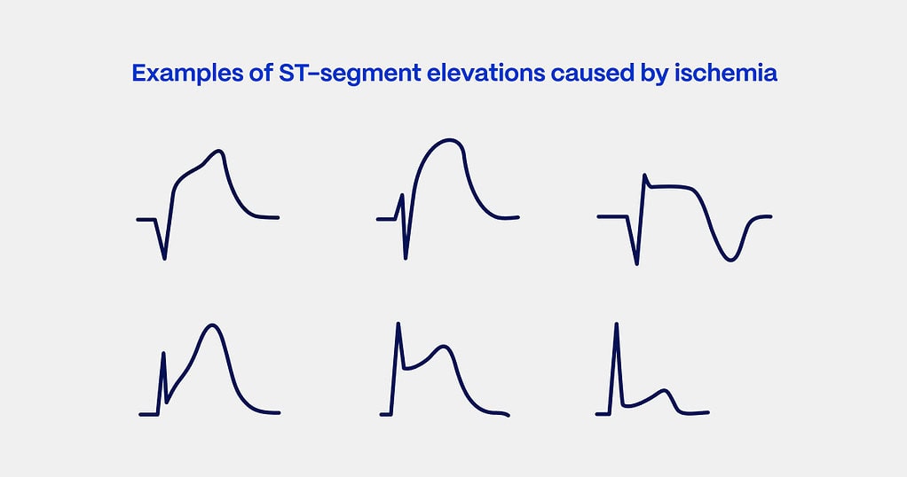 STEMI ECG criteria examples ST-segment elevations caused by ischemia