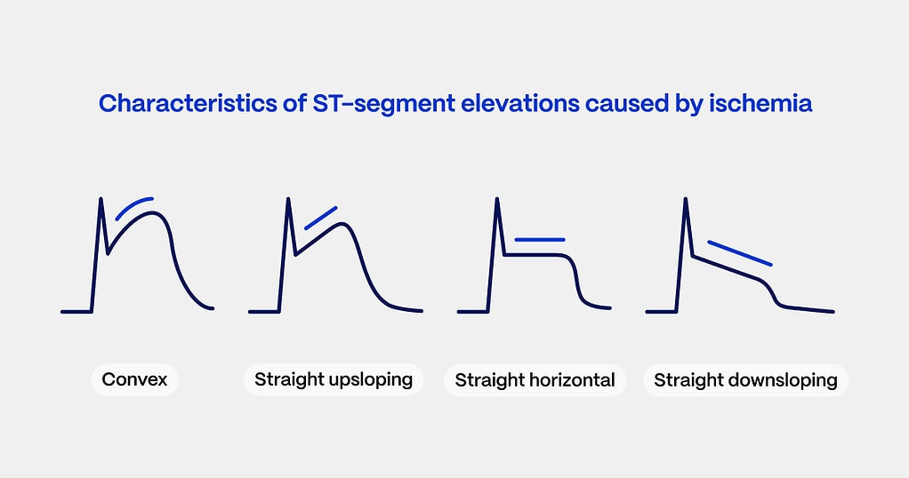 STEMI ECG criteria examples ST-segment elevations caused by ischemia