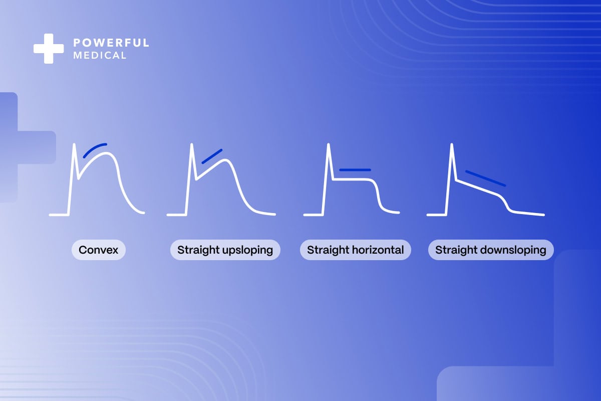 STEMI-ECG-Criteria-ST-elevations-caused-by-ischemia-blog-cover