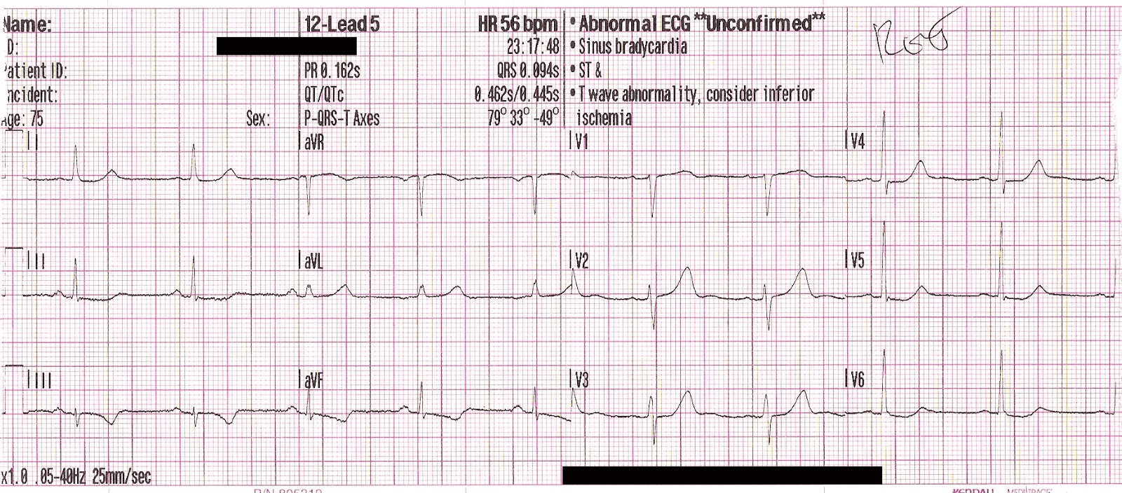 Advanced STEMI Detection and Improved Cath Lab Activation through ECG Transmission and Notifications