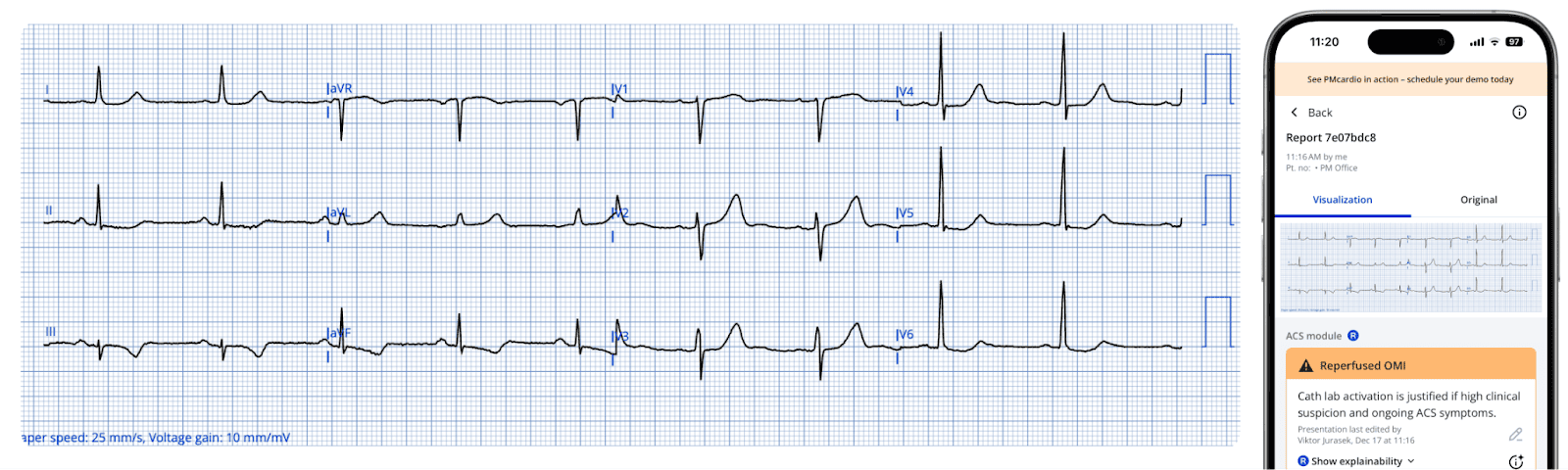 Advanced STEMI Detection and Improved Cath Lab Activation through ECG Transmission and Notifications