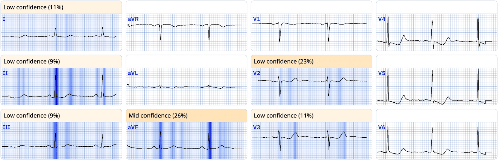 Advanced STEMI Detection and Improved Cath Lab Activation through ECG Transmission and Notifications