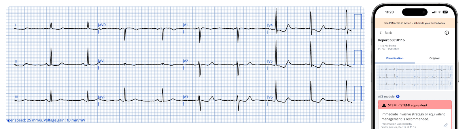 Advanced STEMI Detection and Improved Cath Lab Activation through ECG Transmission and Notifications