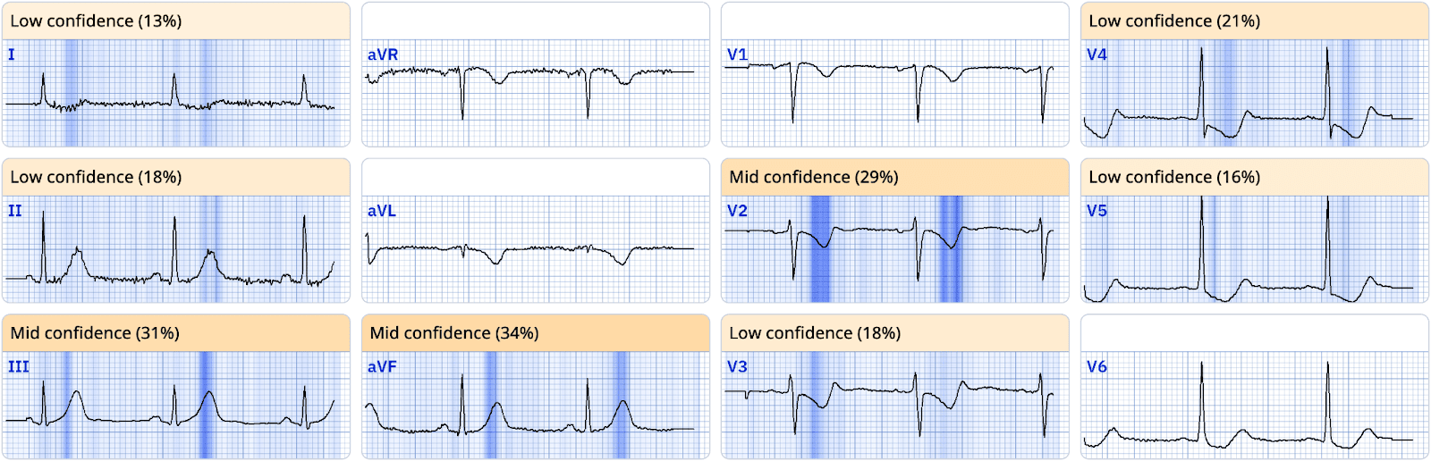 Advanced STEMI Detection and Improved Cath Lab Activation through ECG Transmission and Notifications