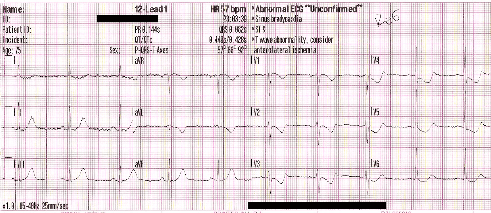 Advanced STEMI Detection and Improved Cath Lab Activation through ECG Transmission and Notifications