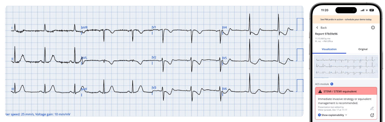 Advanced STEMI Detection and Improved Cath Lab Activation through ECG Transmission and Notifications