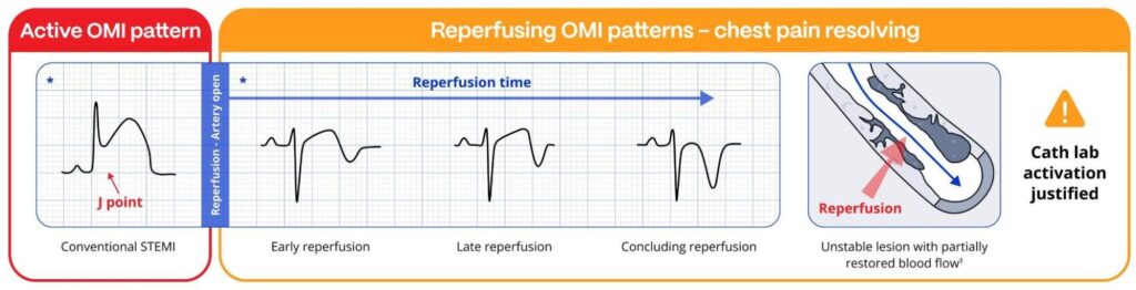 Advanced STEMI Detection and Improved Cath Lab Activation through ECG Transmission and Notifications