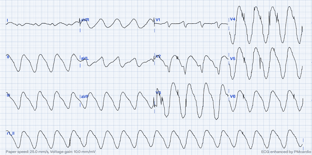 ECG diagnostic of hyperkalemia - severe stages of hyperkalemia