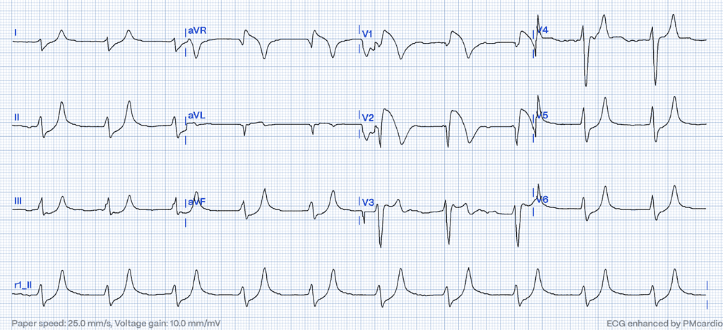 case of hyperkalemia, the ECG can mimic the ST-elevation pattern seen in myocardial infarction (STEMI)