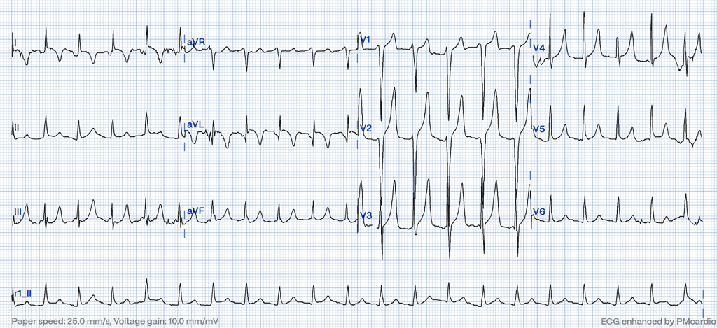 ECG diagnostic of hyperkalemia