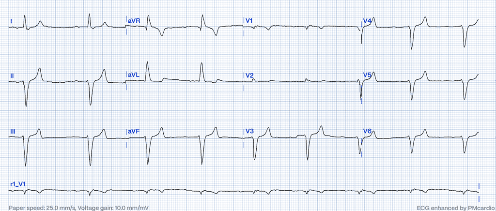 Hyperkalemia - ECG changes 