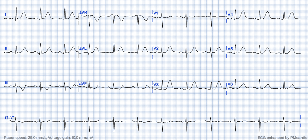 Unmasking Hyperkalemia: Highlighting Critical ECG Changes