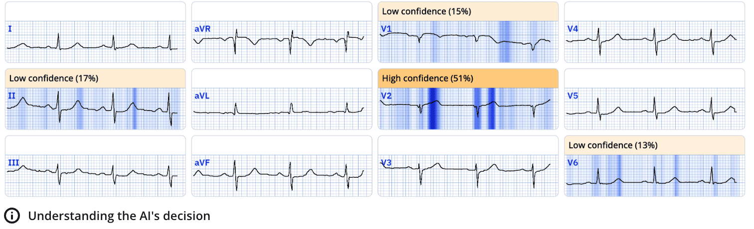 The Explainability Feature in PMcardio: With Human-Centered Design in Mind