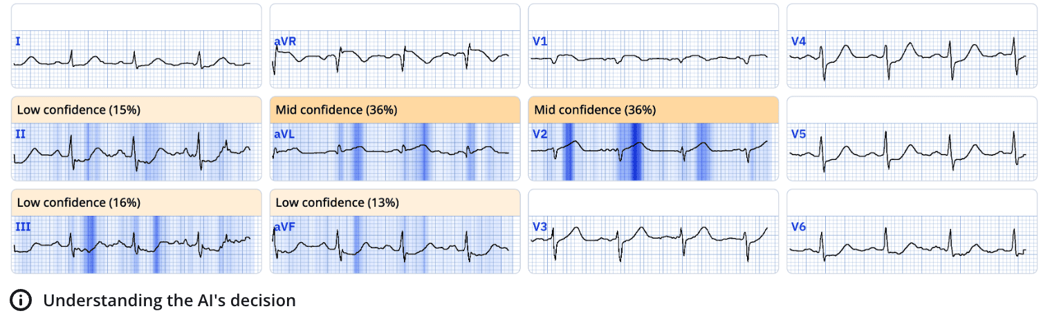 The Explainability Feature in PMcardio: With Human-Centered Design in Mind