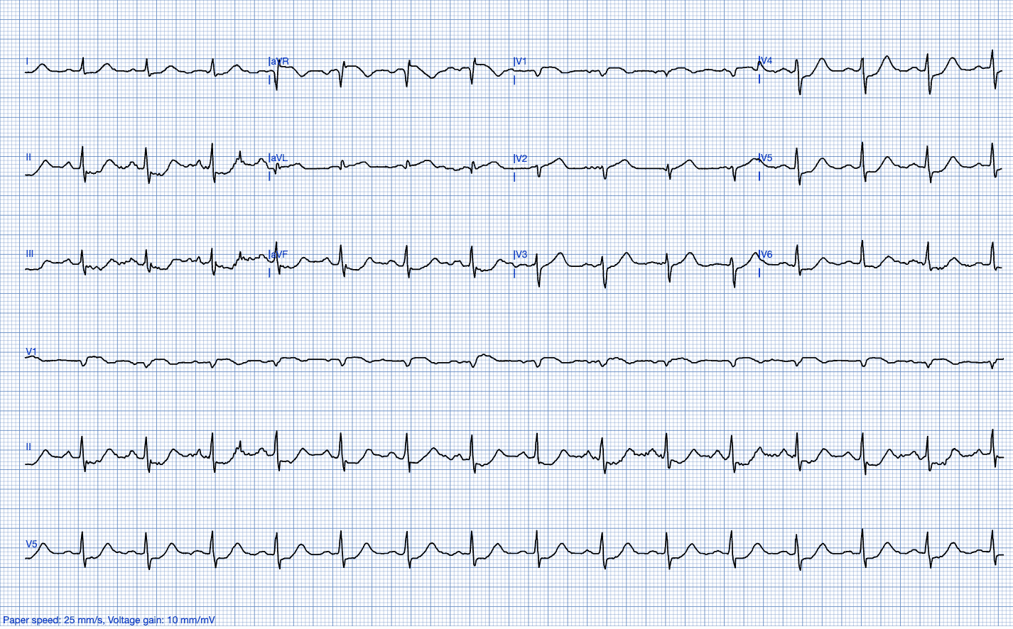 The Explainability Feature in PMcardio: With Human-Centered Design in Mind