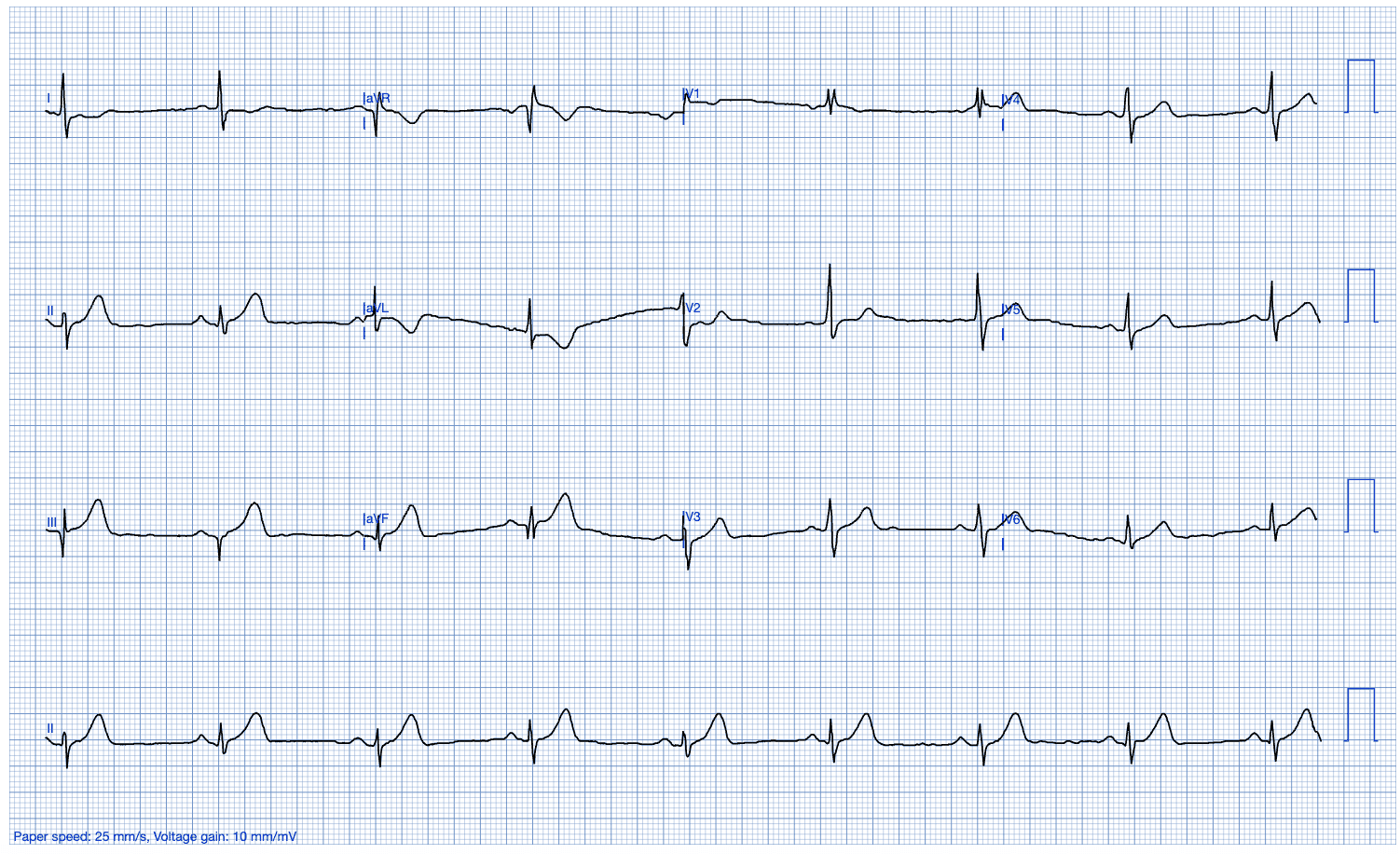 The Explainability Feature in PMcardio: With Human-Centered Design in Mind