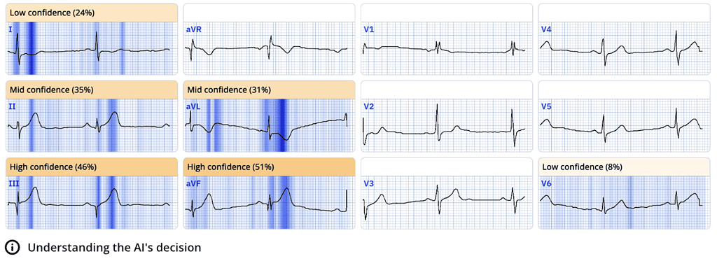 The Explainability Feature in PMcardio: With Human-Centered Design in Mind